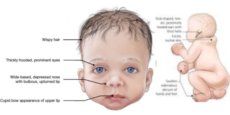 Noonan Syndrome